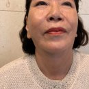 유투성형외과의원 | 압구정 코성형 휜코교정 하러 다녀온 후기에요.