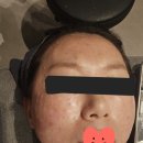 밴스의원 | [웨딩관리] [스킨부스터] 밴스의원 여의도점 리쥬베룩 리얼 후기(찐 내돈내산)