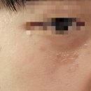 메디캐슬의원 | 편평사마귀 제거 후기_굴포천 피부과