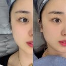 의정부역 피부과 턱선라인케어 미글로우리프팅 턱보톡스 가격 후기