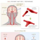 (체증형,10년후2배)뇌혈관질환 진단비 특별약관과 뇌혈관질환 진단비 특별약관의 비교 이미지