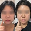 양이멍이 | 수원 영통역피부과 인모드FX 얼굴라인 정리 내돈내산 후기