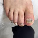 푸스케어 원주점 | 푸스케어 원주점 방문 후기 원주무좀으로 고민한다면