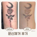 경춘북로 | 남양주별내피부과 피코레이저문신제거 엄청나게 옅어진 후기(3)