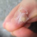 연성중앙약국 | 특징, 굳은살과 차이점, 티눈 종류, 주의할 점, 예방법, 티눈밴드 가격, 바른 사용법, 티눈밴드 사용 후기