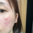 영락온누리약국 | 2동탄 피부과 추천 후즈후 모낭염 주사피부염 치료 약 부작용