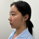 민트성형외과의원 | 민트실리프팅 이벤트 후기 (리비안성형외과)