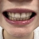 증산밝은미소치과의원 | 창원 교정전문치과 추천 창원 교정치과 밝은미소치과 돌출입교정 덧니교정 앞니교정 뻐드렁니 교정...