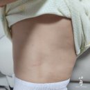 10개월 아기 아토피, 알레르기 고신대병원 진료후기