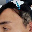 인천 탈모증모 &#39;박미증모가발&#39; 가성비+감쪽같음(수제) 리얼한전후(간절하신분들 꼭보세요)