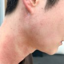 유어의원 | [분당] 미금역 유어라인의원 편평사마귀 제거, 2주간의 기록 / 내돈내산 후기 (극혐주의)