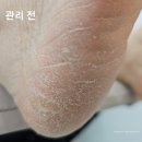 중랑구 발각질 전문, 중랑역 네일을 정하다 발각질 관리 받고 온 효도템 후기