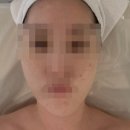 수원 여드름 케어 전문 에클라스킨