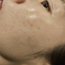 얼굴 잡티 제거와 레이져 효과 너무 좋은 로덱스 스킨앤왁싱 옥정점 후기