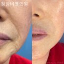 청담비엘의원 네이버블로그