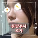 예비신부 물광주사 효과 시기 유지 기간 후기