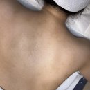 셀앤수 | 세종등드름필링, 예비신부 등드름 고민 전후 변화 후기｜셀앤수 세종보람점