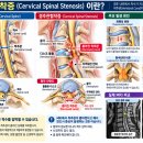 경추관협착증이란? 목디스크와 다른 원인부터 척수 압박 증상, MRI 진단과 치료까지!! 이미지