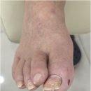 풀리 | 대전 탄방동 내성발톱 발톱무좀 복합관리 후기 페디쿱스 동성풀리메디