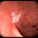동일한 급성 출혈성 위궤양 환자의 출혈 뒤 1주인 2010년 12월 10일 소견 이미지