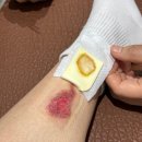 김지훈피부과의원 | 수원 망포 화상전문병원 후기: 새솔의원 주차, 접수, 예약 방법 (상처 주의)