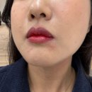 안의한의원 | 노원 한의원 콜린성두드러기, 피부묘기증 치료 병원 후기
