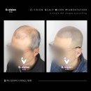디비전스칼프 수원본점 네이버블로그