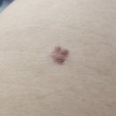 아문성형외과의원 | 아문성형외과 비후성반흔 흉터수술 흉터재봉합 후기 part.1