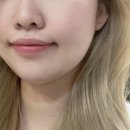 삐땅기의원 | 신사피부과 / 강남피부과 추천✨삐땅기의원 싸이블로리프팅 관리 후기💛