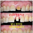 성형치과기공소 | 강남논현동치과 60대 치아부러짐 - 신경치료하고 기둥심고 앞니 크라운 잘하는곳! 가격/과정/후기/부작용.