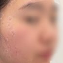 야탑 밴스의원 | 야탑 피부과 '밴스의원' 얼굴과 팔뚝 점, 편평사마귀 제거 가격 및 후기