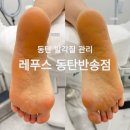 동탄발각질관리 레푸스 동탄반송점 후기, 발뒤꿈치 각질 관리 전후