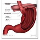Reflux esophagitis 이미지