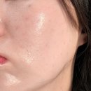 천사약국 | 명동 시청역피부과 쥬베룩 스킨부스터 모공 추천 1주차 후기