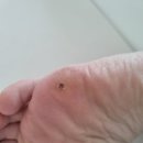 미누네 | 물집방지패드_미누네 굳은살 티눈 물집 보호패드 투명 사용 후기