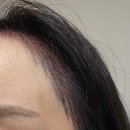리더 헤어라인 | 여자 헤어라인교정 : 모발이식수술후기 수술당일 모발이식1일차 리얼후기