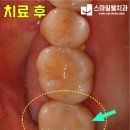 스마일디자인 치과기공소 이미지