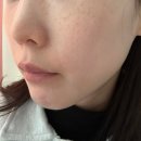 속편안의원 | 우유빛의원 리쥬란힐러 후기｜써마지·잡티레이저까지 한 번에 받아본 솔직 후기