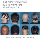 '이 약' 먹고 탈모 3명 중 1명 모발 자랐다 이미지