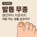 발톱 무좀 원인 치료 | 재발 막는 생활 습관 | 발톱 색 | 두꺼워지는 이유