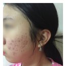 마음모아한의원 | 여드름전문한의원 가격과 비용 직접다녀보고 공유해요