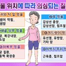 림프종과 멍과 멍울의 관계 이미지