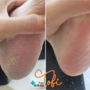 위례 갈라지며 하얗게 일어나는 뒷꿈치 발각질 제거 이미지