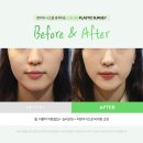 지방흡입 후기 얼굴 좌우 비대칭 심하다면 &#39;이것&#39; 하세요