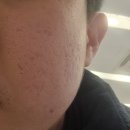 해운대 중동역 J피부과의원 여드름흉터 프락셀 상담솔직후기