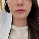 강남라라필가격+얼굴지방분해주사 잘하는곳 후기