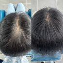 면목천로 | 정수리 초기탈모에 효과 좋은 한올증모술 ‘손길증모 상봉점’강력추천 및 상세 후기