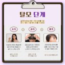 신림초등학교 | M자 탈모 생활 습관만으로 좋아질까? 실제 효과와 한계 현실 정리｜신림역탈모병원