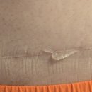 에스씨마케팅 | [흉터 색소침착 연고 더마에스씨겔] 복부 수술 흉터 자국에 써본 후기