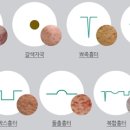 VL 브이엘 여드름 + 피부톤 레이저